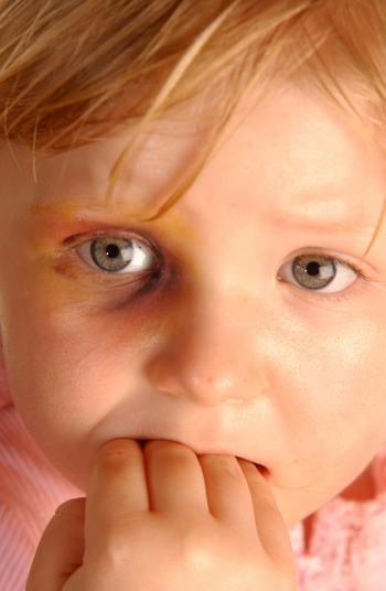 girl with black eye