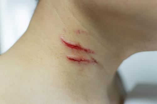 cuts and scratches